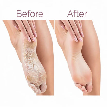 Electric Pedicure Foot File Callus Remover (مبرد كهربائي للقدمين لإزالة الجلد الميت والكالو)